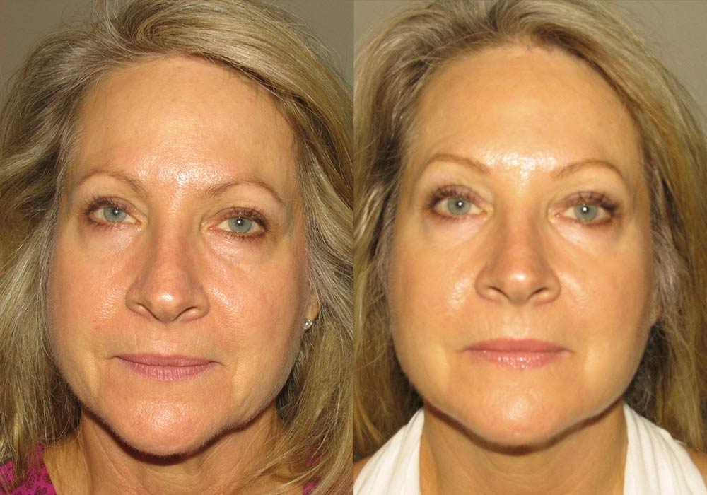 Dermal Fillers Photo Patient 1 | Guyette Facial & Oral Surgery, Scottsdale, AZ