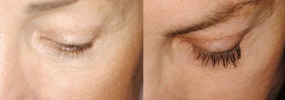 Latisse Photo Patient 1 | Guyette Facial & Oral Surgery, Scottsdale, AZ