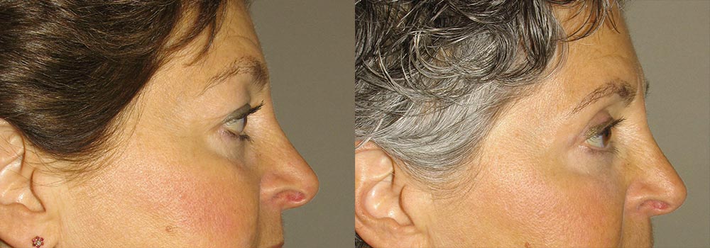 Eyelid Patient 10 | Guyette Facial & Oral Surgery, Scottsdale, AZ