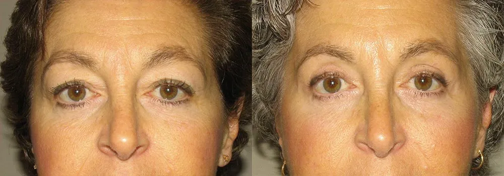 Eyelid Patient 10 | Guyette Facial & Oral Surgery, Scottsdale, AZ