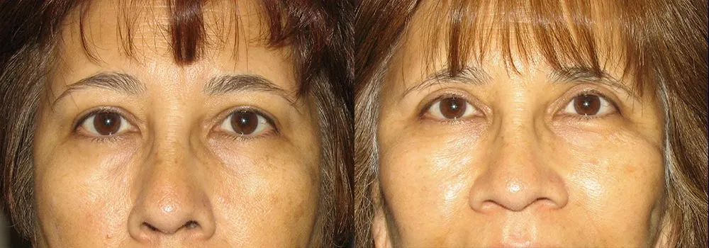 Eyelid Patient 11 | Guyette Facial & Oral Surgery, Scottsdale, AZ