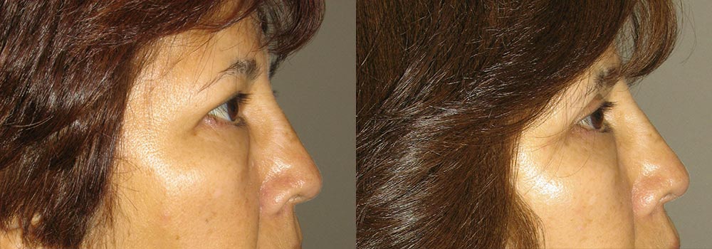 Eyelid Patient 11 | Guyette Facial & Oral Surgery, Scottsdale, AZ