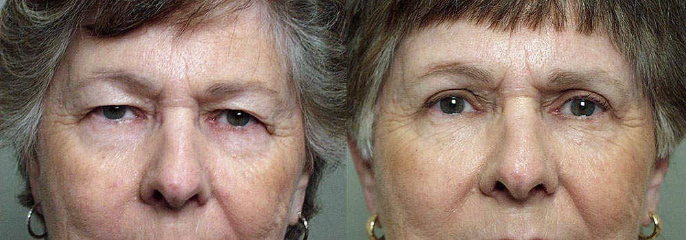 Eyelid Patient 12 | Guyette Facial & Oral Surgery, Scottsdale, AZ