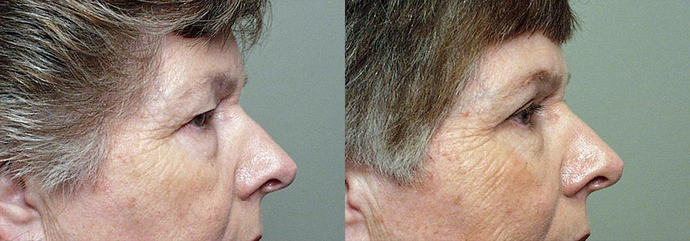 Eyelid Patient 12 | Guyette Facial & Oral Surgery, Scottsdale, AZ