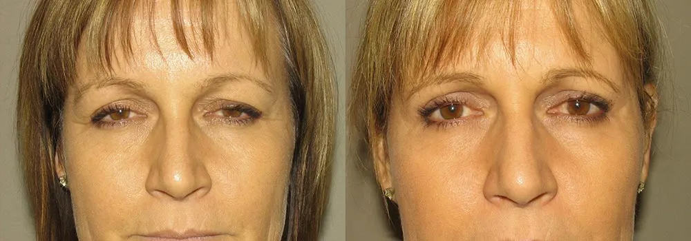 Eyelid Patient 13 | Guyette Facial & Oral Surgery, Scottsdale, AZ