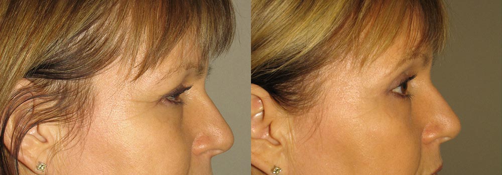 Eyelid Patient 13 | Guyette Facial & Oral Surgery, Scottsdale, AZ