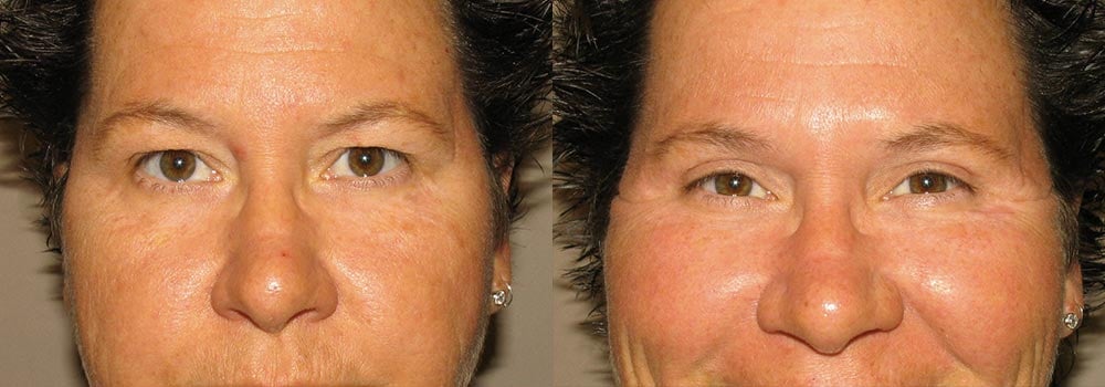 Eyelid Patient 15 | Guyette Facial & Oral Surgery, Scottsdale, AZ
