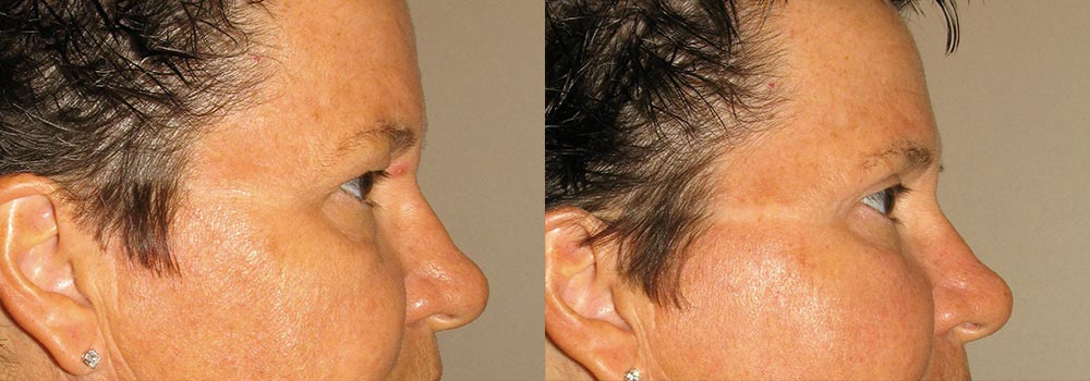 Eyelid Patient 15 | Guyette Facial & Oral Surgery, Scottsdale, AZ