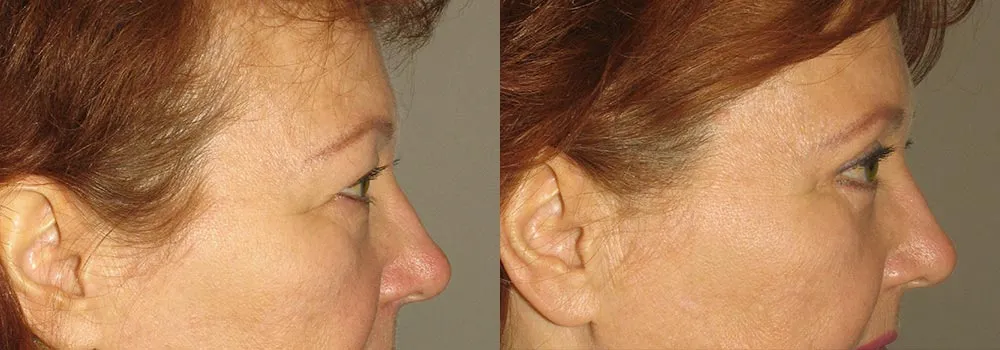 Eyelid Patient 1 | Guyette Facial & Oral Surgery, Scottsdale, AZ