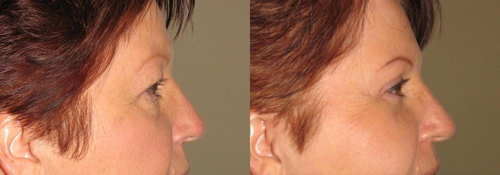 Eyelid Patient 2 | Guyette Facial & Oral Surgery, Scottsdale, AZ