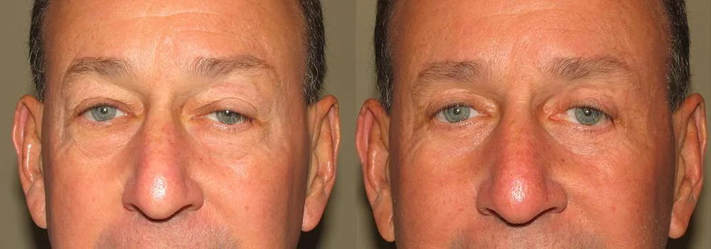 Eyelid Patient 3 | Guyette Facial & Oral Surgery, Scottsdale, AZ