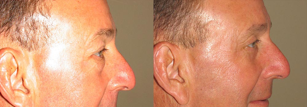 Eyelid Patient 3 | Guyette Facial & Oral Surgery, Scottsdale, AZ