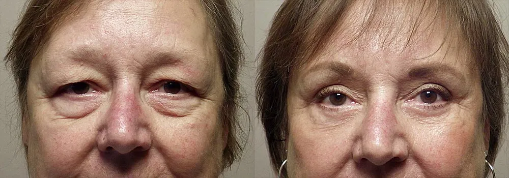Eyelid Patient 4 | Guyette Facial & Oral Surgery, Scottsdale, AZ