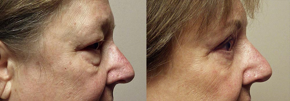 Eyelid Patient 4 | Guyette Facial & Oral Surgery, Scottsdale, AZ