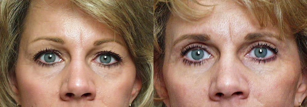 Eyelid Patient 5 | Guyette Facial & Oral Surgery, Scottsdale, AZ