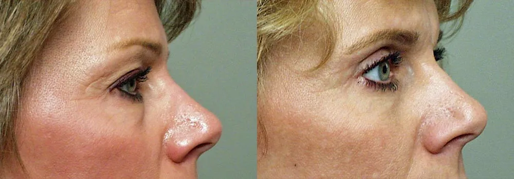 Eyelid Patient 5 | Guyette Facial & Oral Surgery, Scottsdale, AZ