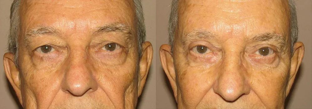 Eyelid Patient 6 | Guyette Facial & Oral Surgery, Scottsdale, AZ