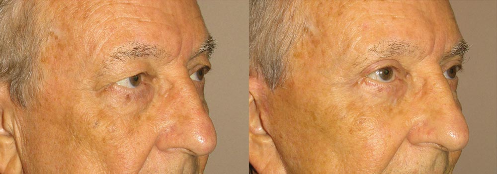 Eyelid Patient 6 | Guyette Facial & Oral Surgery, Scottsdale, AZ