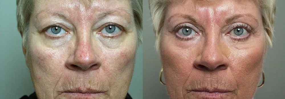 Eyelid surgery patient before and after in Scottsdale & Avondale, AZ