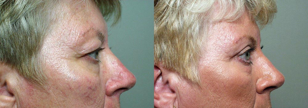 Eyelid Patient 7 | Guyette Facial & Oral Surgery, Scottsdale, AZ