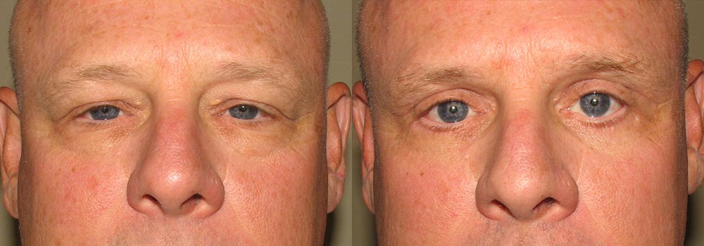 Eyelid Patient 8 | Guyette Facial & Oral Surgery, Scottsdale, AZ