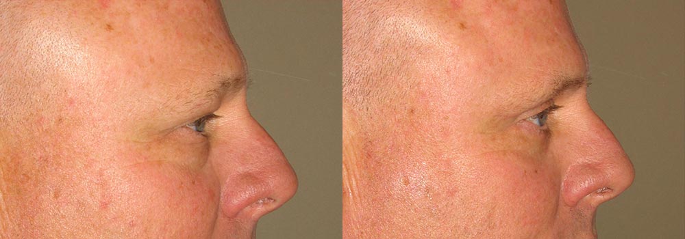 Eyelid Patient 8 | Guyette Facial & Oral Surgery, Scottsdale, AZ