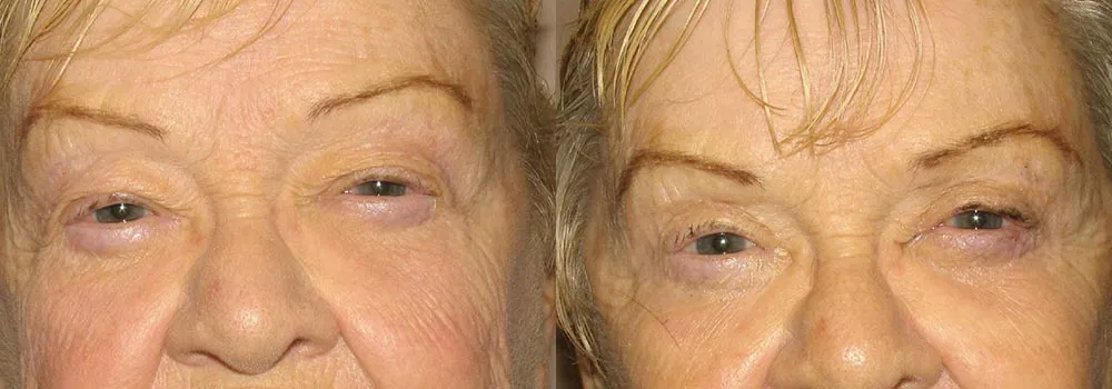 Eyelid Patient 9 | Guyette Facial & Oral Surgery, Scottsdale, AZ