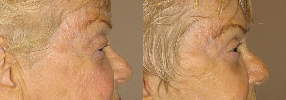 Eyelid Patient 9 | Guyette Facial & Oral Surgery, Scottsdale, AZ