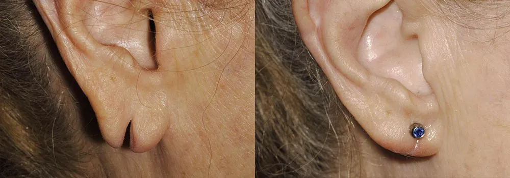 Earlobe revision patient before and after in Scottsdale & Avondale, AZ