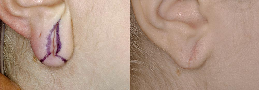 Earlobe Revision Patient 2 | Guyette Facial & Oral Surgery, Scottsdale, AZ