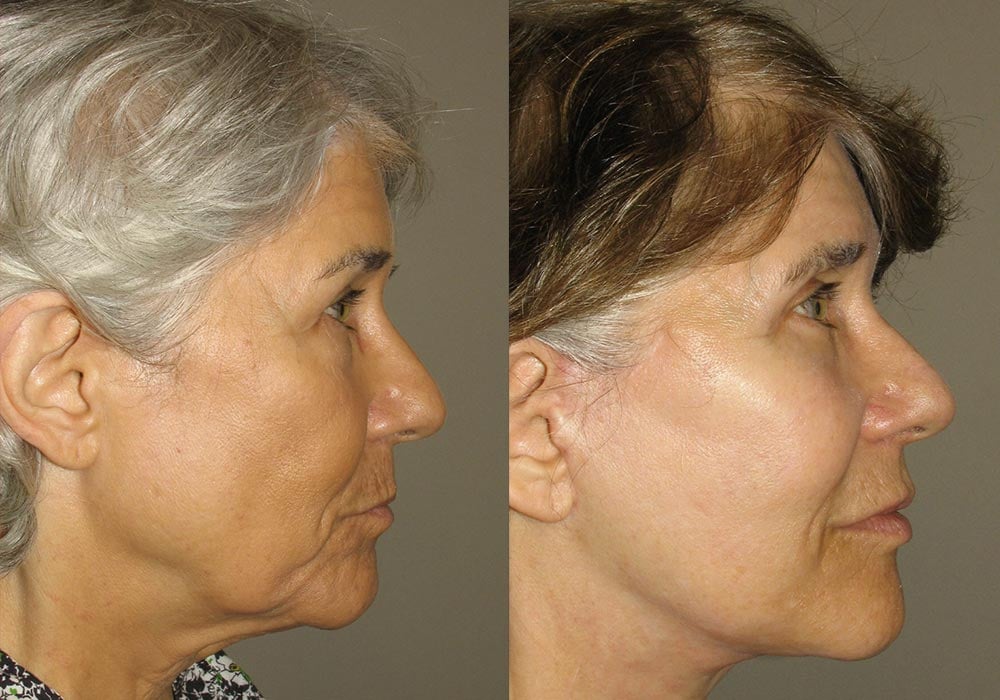 Facelift Patient 1 | Guyette Facial & Oral Surgery, Scottsdale, AZ