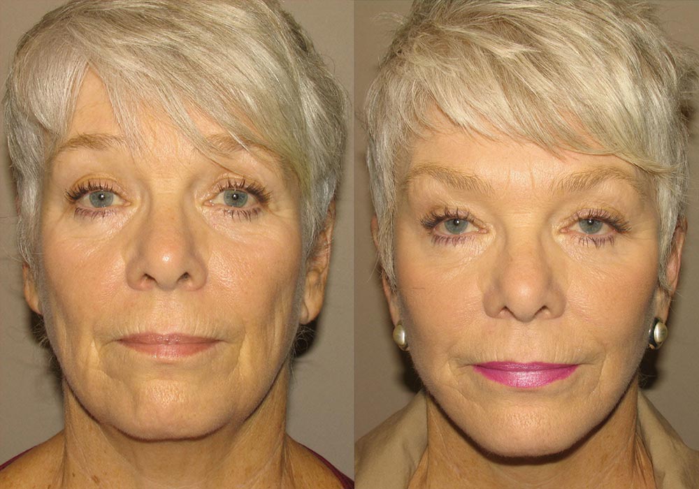 Facelift Patient 2 | Guyette Facial & Oral Surgery, Scottsdale, AZ