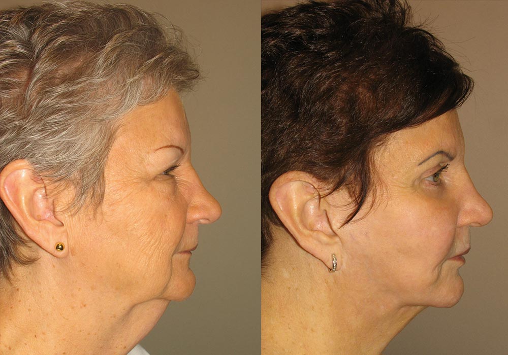 Facelift Patient 3 | Guyette Facial & Oral Surgery, Scottsdale, AZ