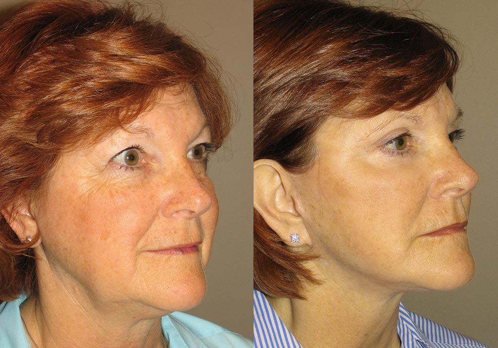 Facelift Patient 4 | Guyette Facial & Oral Surgery, Scottsdale, AZ