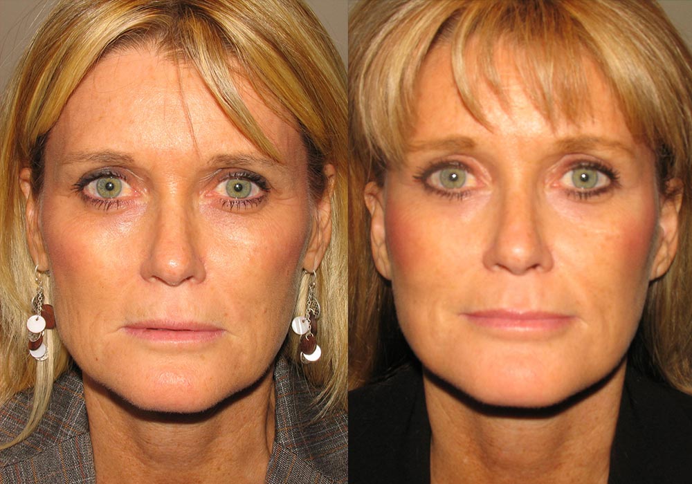 Facelift Patient 5 | Guyette Facial & Oral Surgery, Scottsdale, AZ