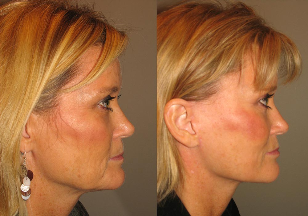 Facelift Patient 5 | Guyette Facial & Oral Surgery, Scottsdale, AZ
