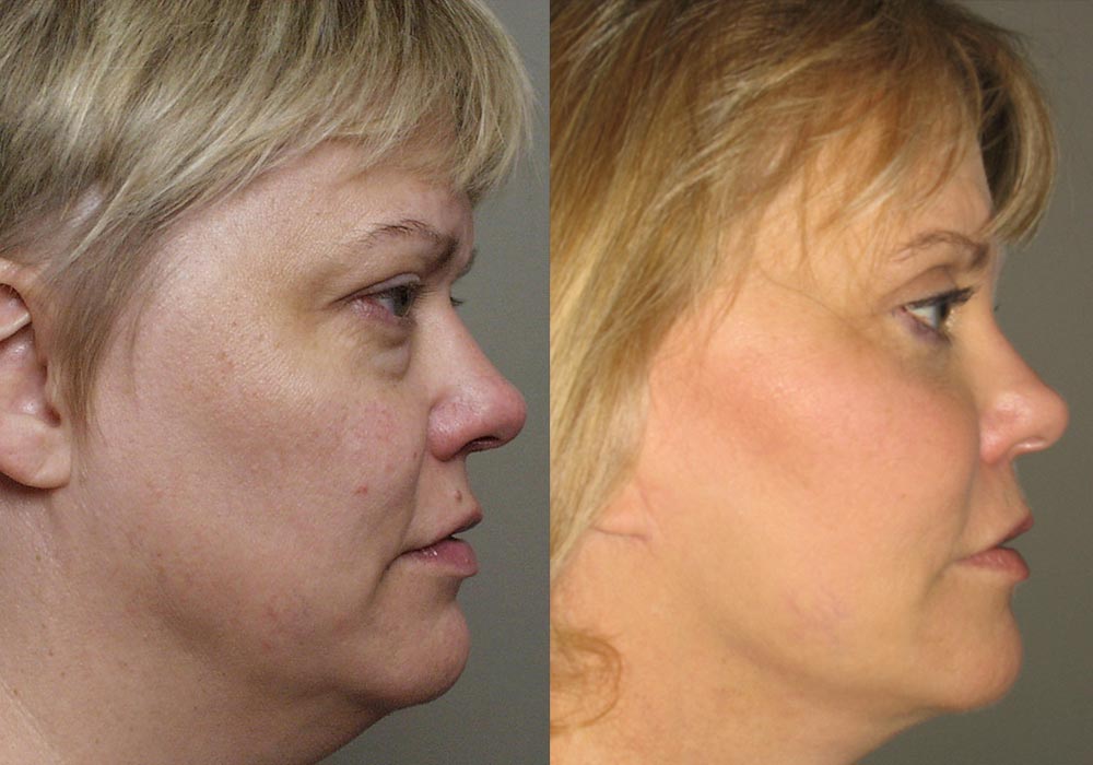 Facelift Patient 6 | Guyette Facial & Oral Surgery, Scottsdale, AZ