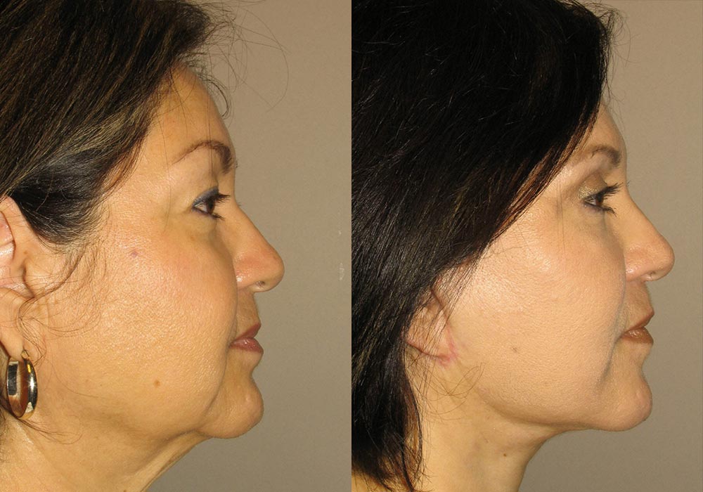 Facelift Patient 7 | Guyette Facial & Oral Surgery, Scottsdale, AZ