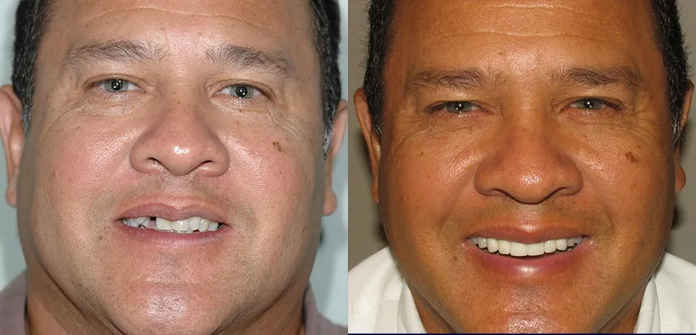 All-on-4 Photo Patient 1 | Guyette Facial & Oral Surgery, Scottsdale, AZ