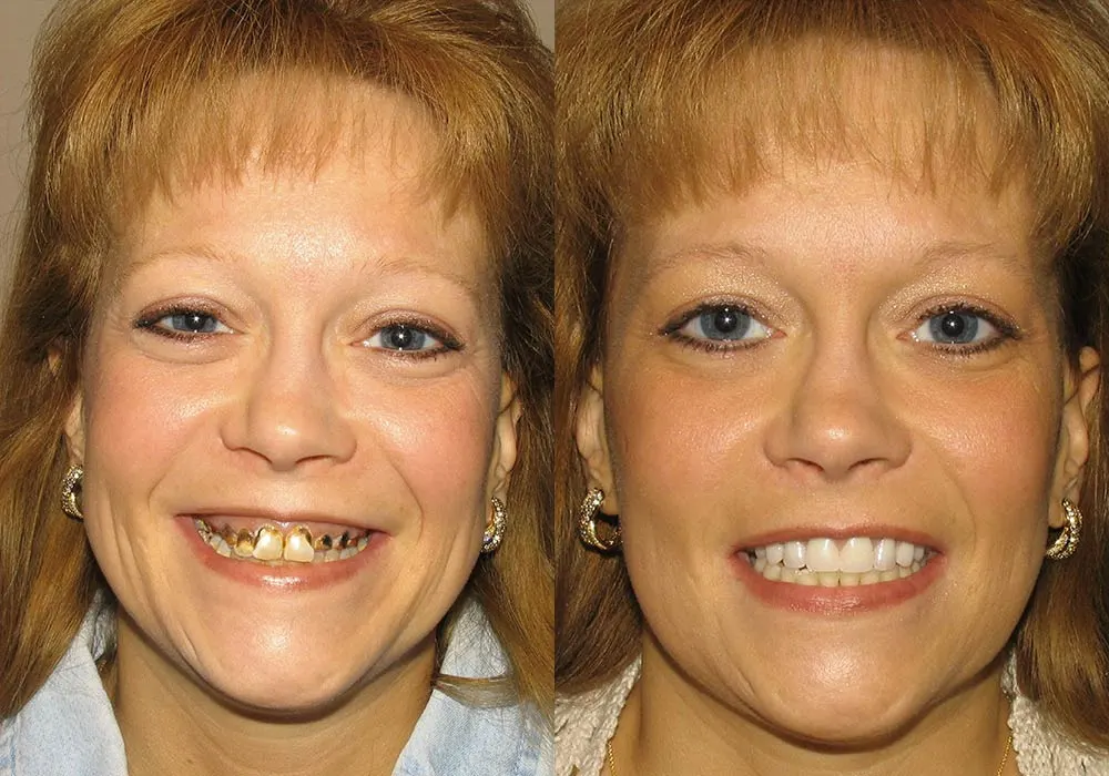 All-on-4 Photo Patient 2 | Guyette Facial & Oral Surgery, Scottsdale, AZ