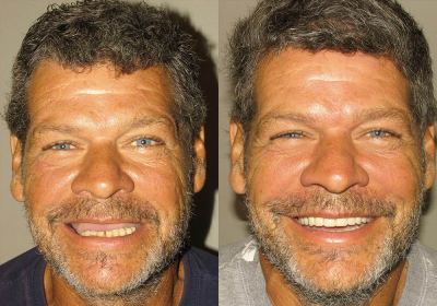 All-on-4 Photo Patient 7 | Guyette Facial & Oral Surgery, Scottsdale, AZ