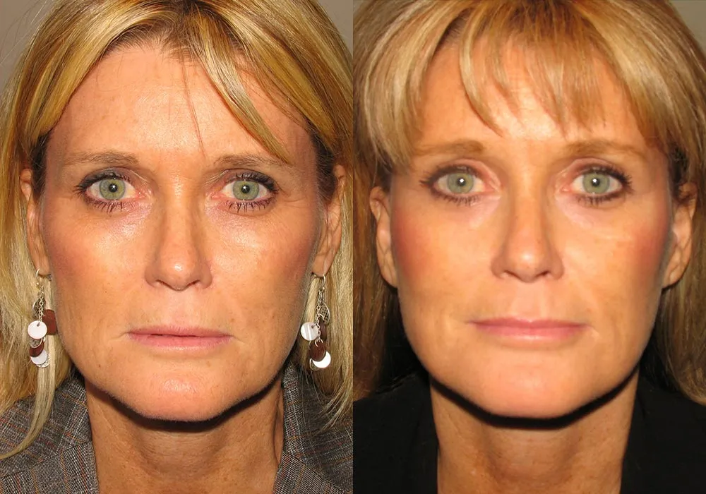 Before and after a brow lift patient in Scottsdale & Avondale, AZ