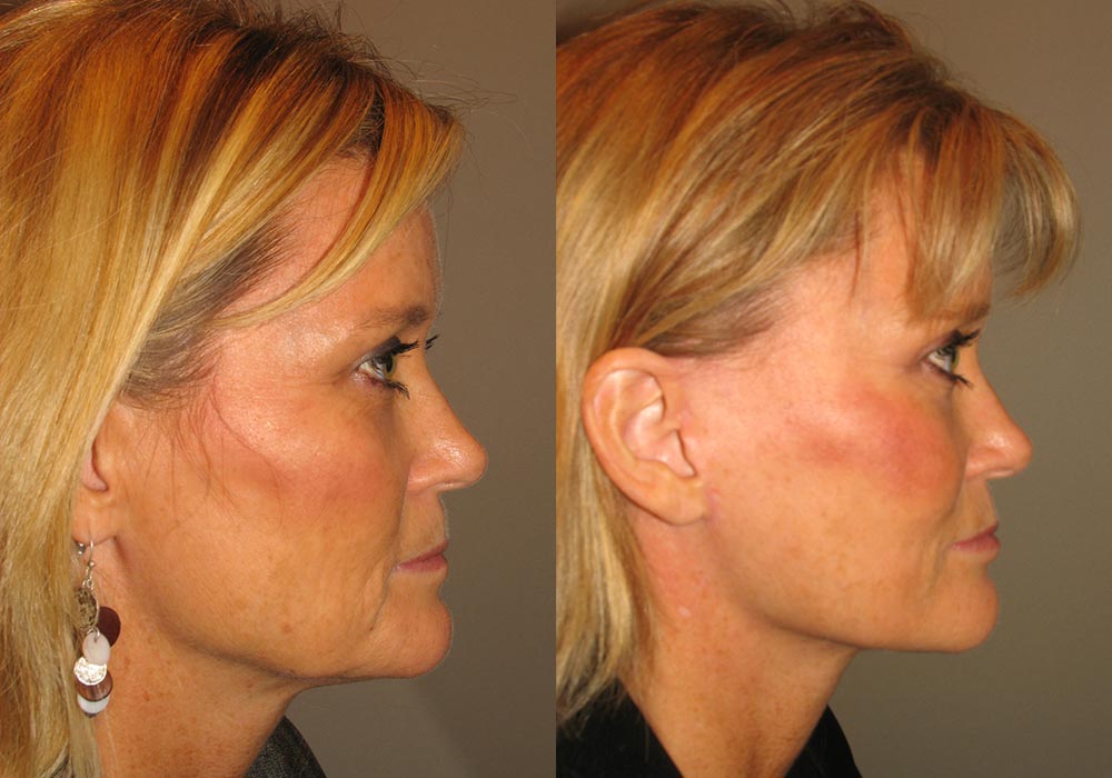 Brow Lift Patient 1 | Guyette Facial & Oral Surgery, Scottsdale, AZ