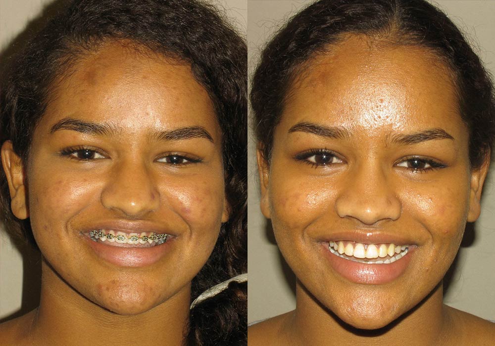 Corrective Jaw Surgery Photo Patient 1