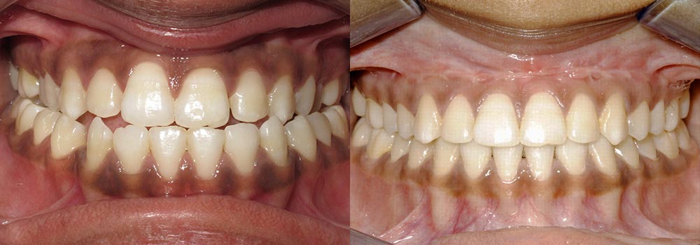 Corrective Jaw Surgery Photo Patient 1 | Guyette Facial & Oral Surgery, Scottsdale, AZ
