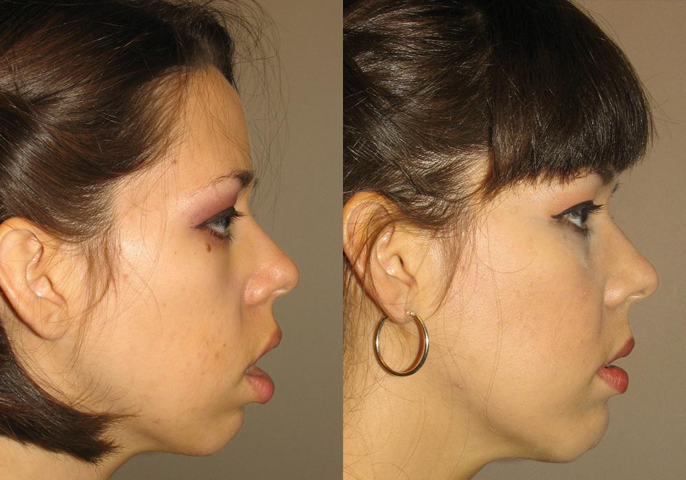 Facial Implants Patient 1 | Guyette Facial & Oral Surgery, Scottsdale, AZ
