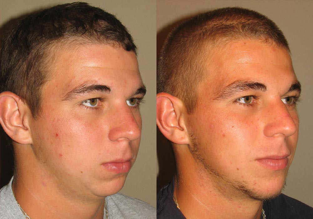 Facial Implants Patient 2 | Guyette Facial & Oral Surgery, Scottsdale, AZ