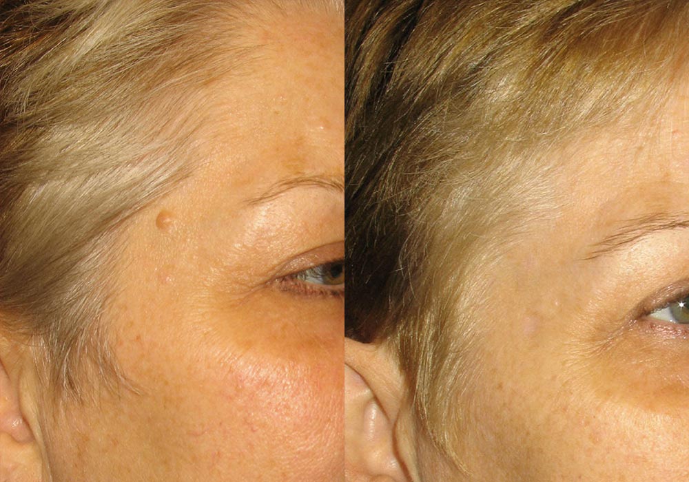 Mole Removal Patient 2 | Guyette Facial & Oral Surgery, Scottsdale, AZ