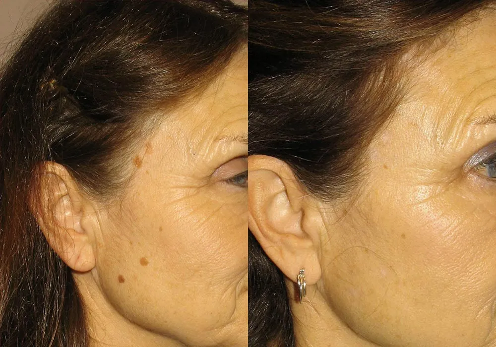 Before and after a mole removal patient in Scottsdale & Avondale, AZ