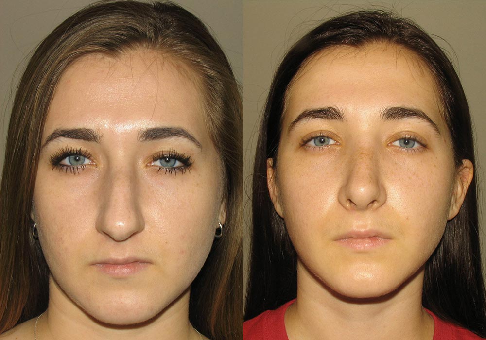Rhinoplasty Patient 1 | Guyette Facial & Oral Surgery, Scottsdale, AZZ